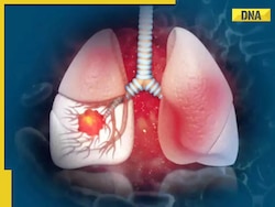 White Lung Syndrome hits children in US; Know its signs, symptoms